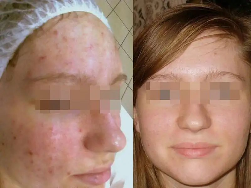 Фото: до и после пилинга Herbs2Peel Alex Cosmetic