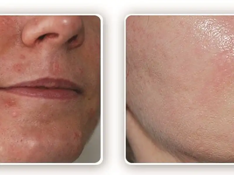 Фото: до и после пилинга Herbs2Peel Alex Cosmetic