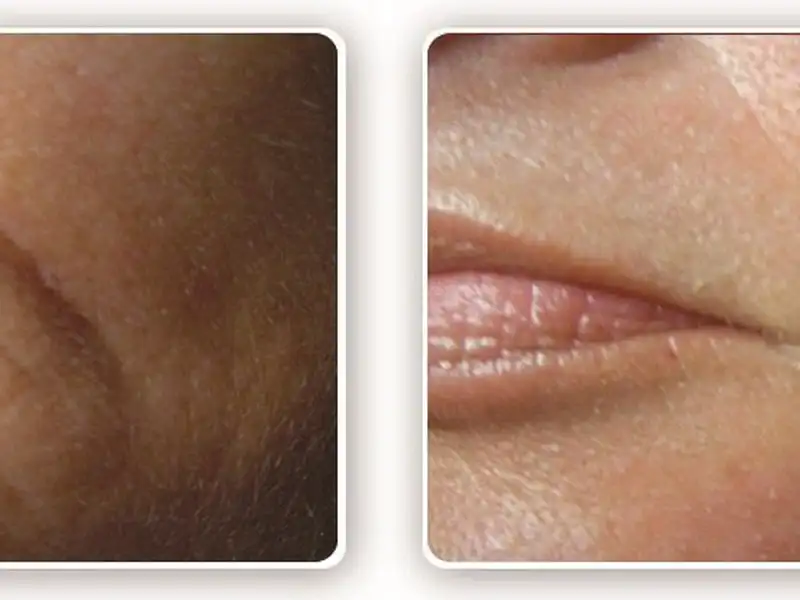 Фото: до и после пилинга Herbs2Peel Alex Cosmetic