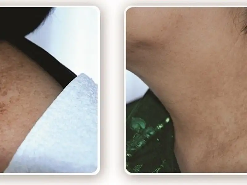 Фото: до и после пилинга Herbs2Peel Alex Cosmetic