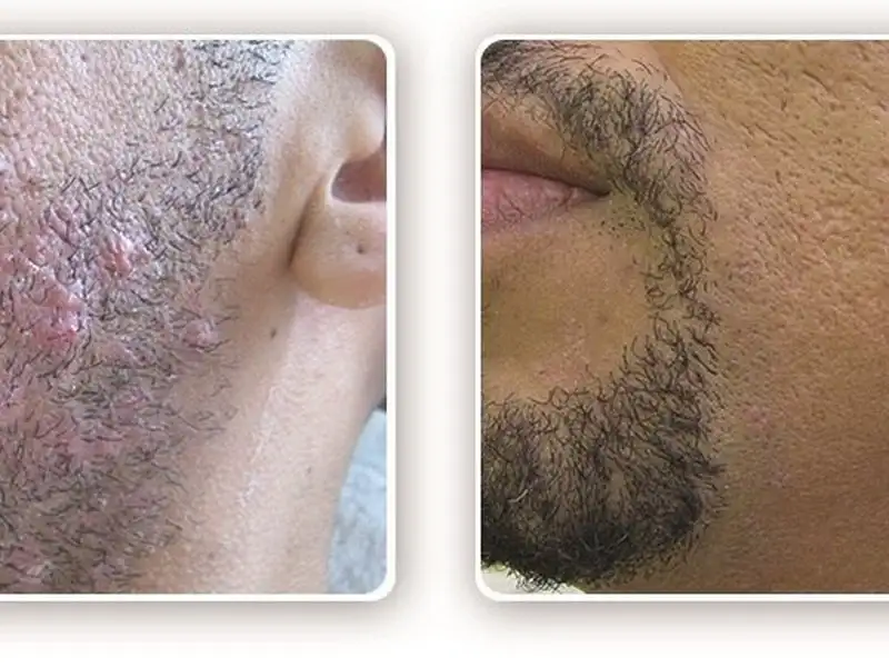 Фото: до и после пилинга Herbs2Peel Alex Cosmetic