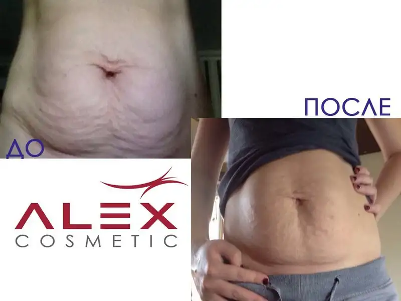 Фото: до и после пилинга Herbs2Peel Alex Cosmetic