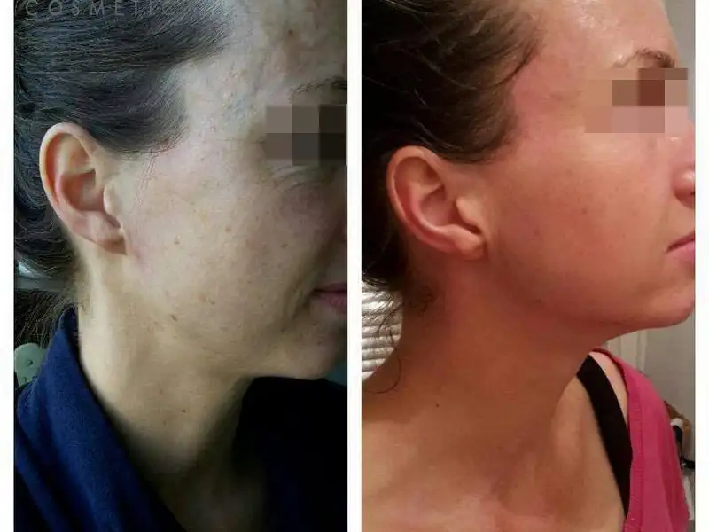 Фото: до и после пилинга Herbs2Peel Alex Cosmetic