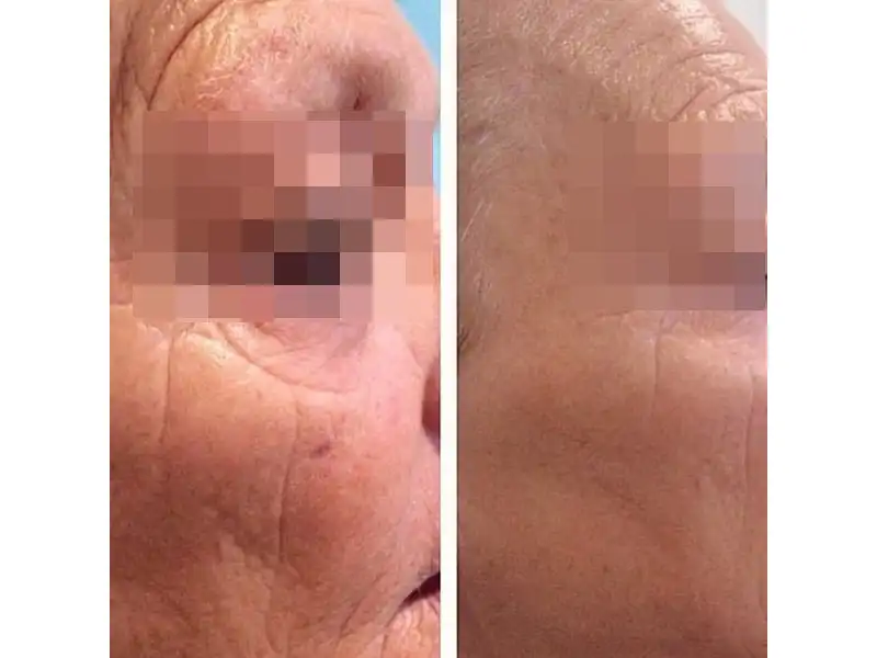 Фото: до и после пилинга Herbs2Peel Alex Cosmetic