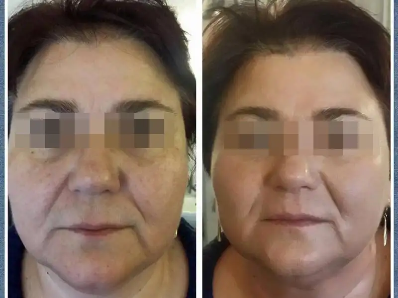 Фото: до и после пилинга Herbs2Peel Alex Cosmetic