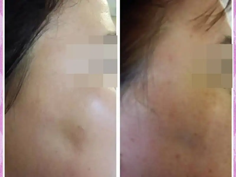 Фото: до и после пилинга Herbs2Peel Alex Cosmetic