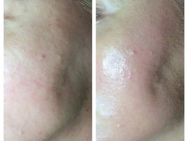 Фото: до и после пилинга Herbs2Peel Alex Cosmetic