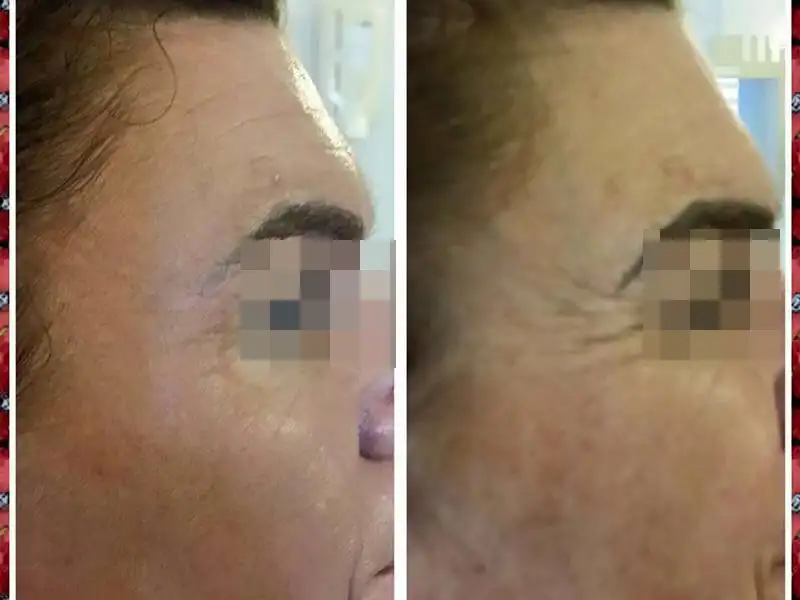 Фото: до и после пилинга Herbs2Peel Alex Cosmetic