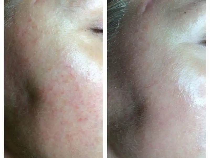 Фото: до и после пилинга Herbs2Peel Alex Cosmetic