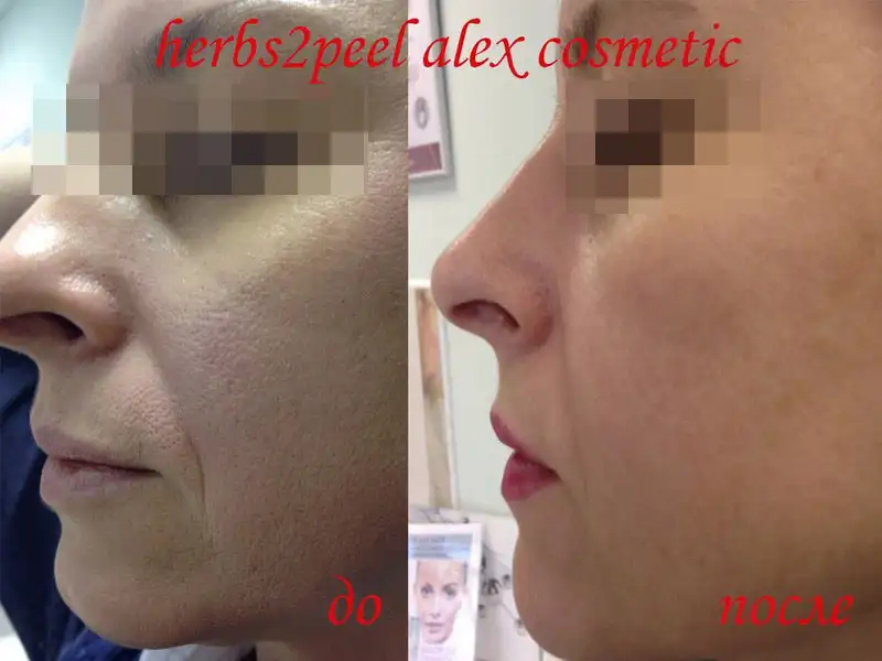 Фото: до и после пилинга Herbs2Peel Alex Cosmetic