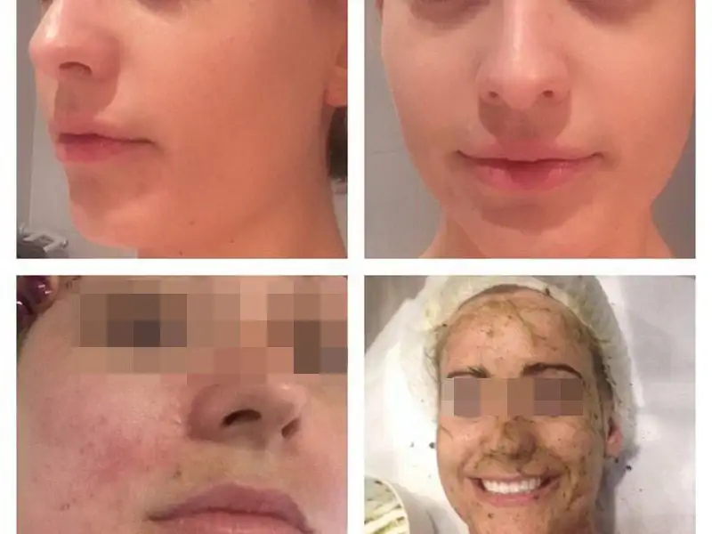 Фото: до и после пилинга Herbs2Peel Alex Cosmetic