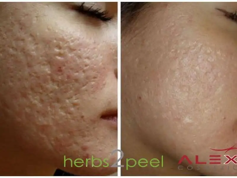 Фото: до и после пилинга Herbs2Peel Alex Cosmetic
