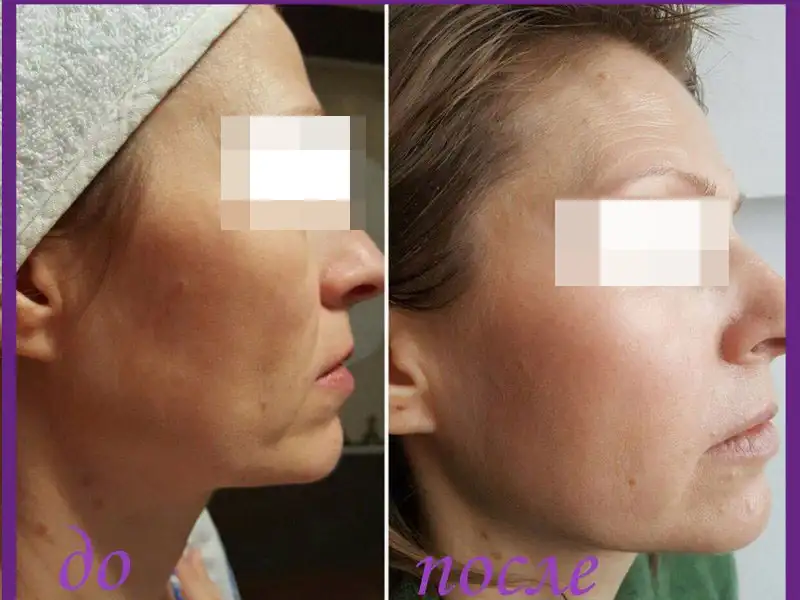Фото: до и после пилинга Herbs2Peel Alex Cosmetic