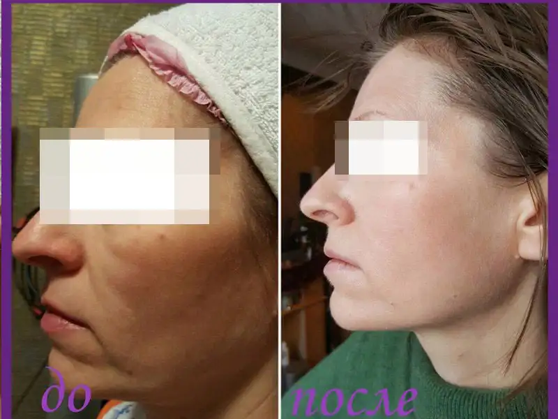 Фото: до и после пилинга Herbs2Peel Alex Cosmetic