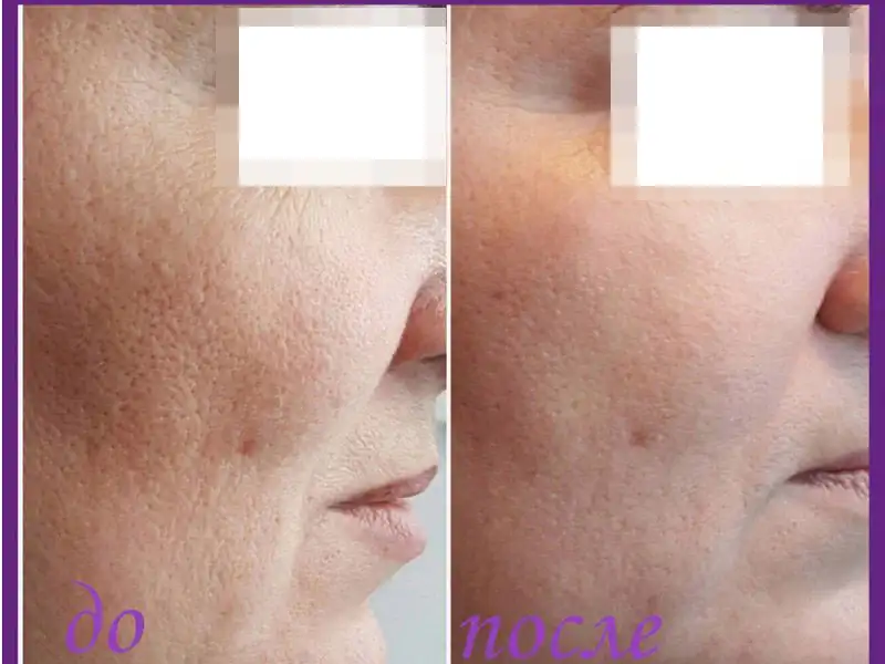 Фото: до и после пилинга Herbs2Peel Alex Cosmetic