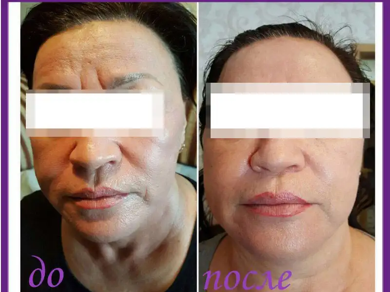 Фото: до и после пилинга Herbs2Peel Alex Cosmetic