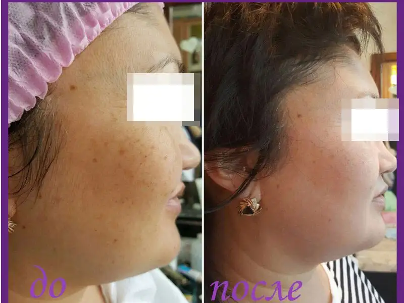 Фото: до и после пилинга Herbs2Peel Alex Cosmetic