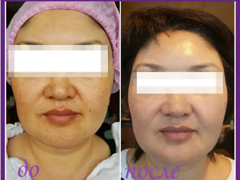 Фото: до и после пилинга Herbs2Peel Alex Cosmetic