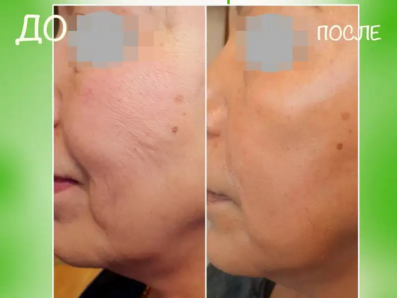 Фото: до и после пилинга Herbs2Peel Alex Cosmetic