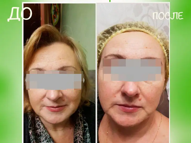 Фото: до и после пилинга Herbs2Peel Alex Cosmetic