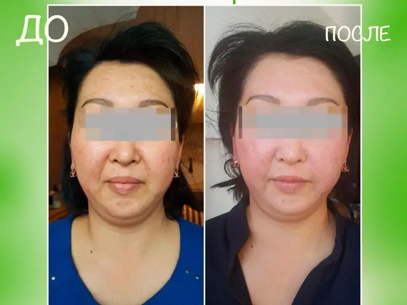 Фото: до и после пилинга Herbs2Peel Alex Cosmetic