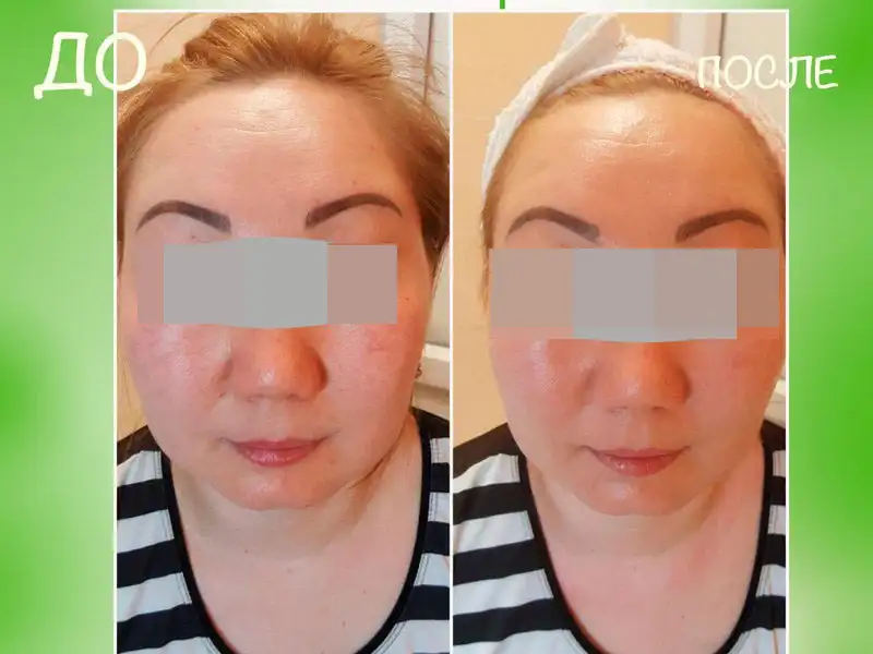 Фото: до и после пилинга Herbs2Peel Alex Cosmetic