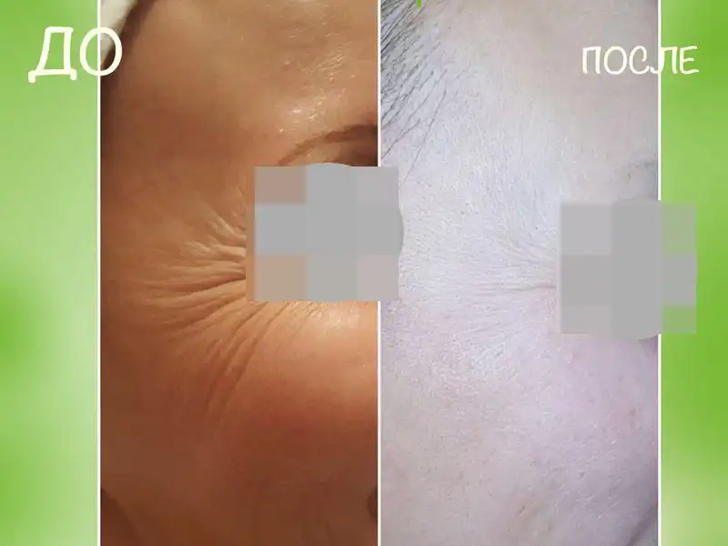 Фото: до и после пилинга Herbs2Peel Alex Cosmetic