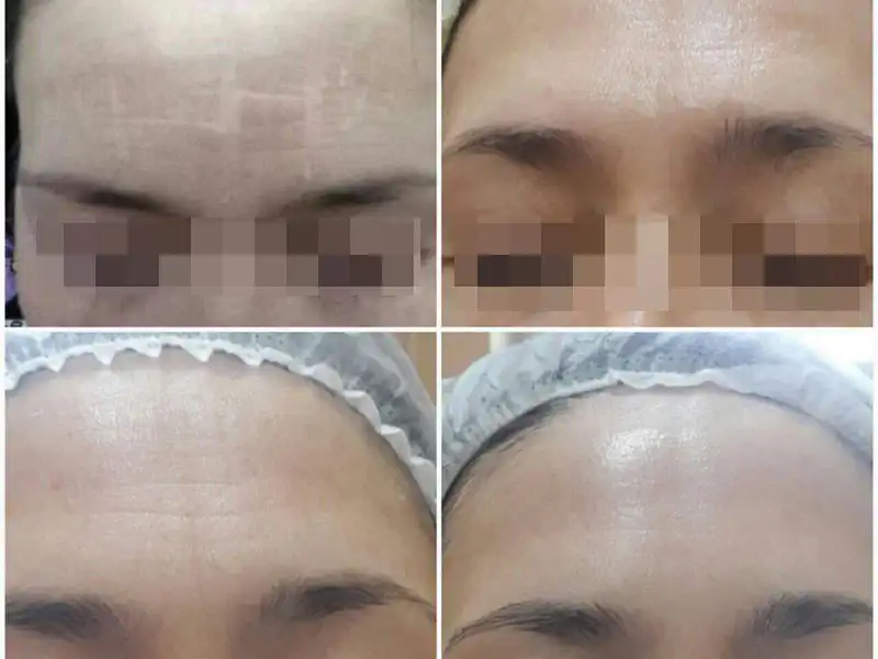 Фото: до и после пилинга Herbs2Peel Alex Cosmetic