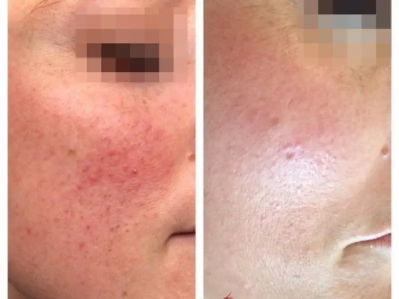 Фото: до и после пилинга Herbs2Peel Alex Cosmetic