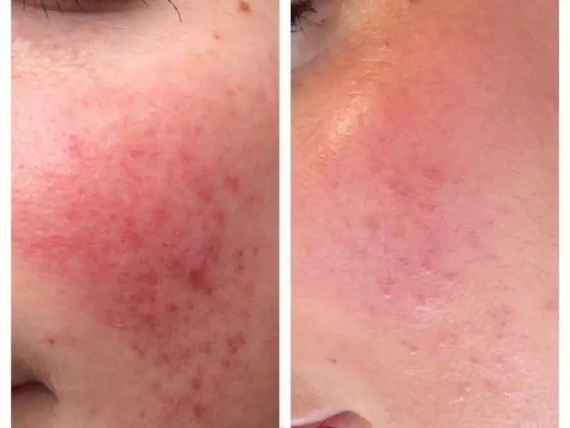 Фото: до и после пилинга Herbs2Peel Alex Cosmetic