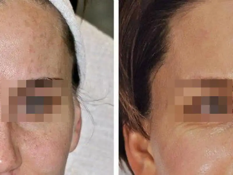 Фото: до и после пилинга Herbs2Peel Alex Cosmetic