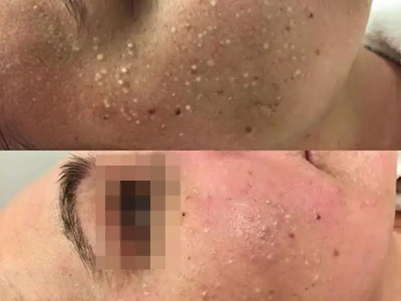 Фото: до и после пилинга Herbs2Peel Alex Cosmetic