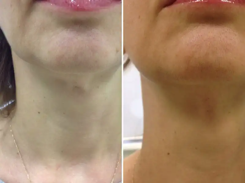 Фото: до и после пилинга Herbs2Peel Alex Cosmetic