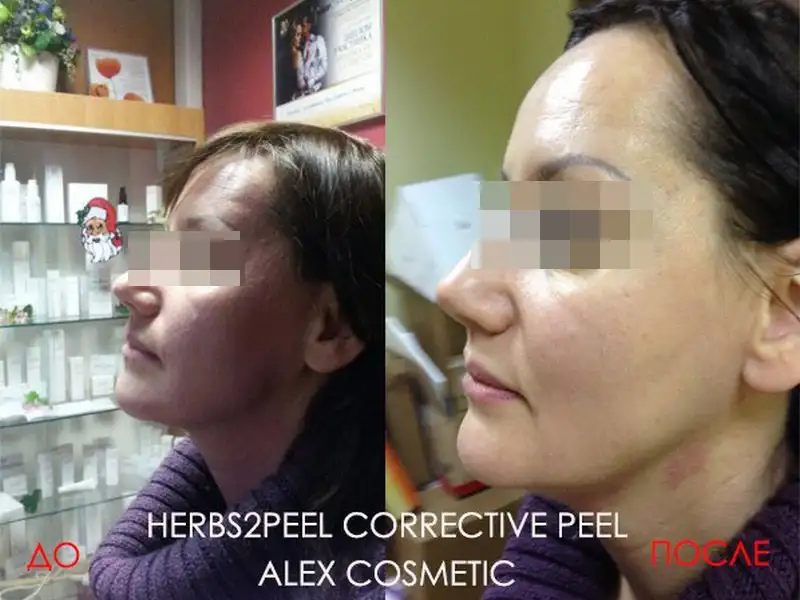 Фото: до и после пилинга Herbs2Peel Alex Cosmetic