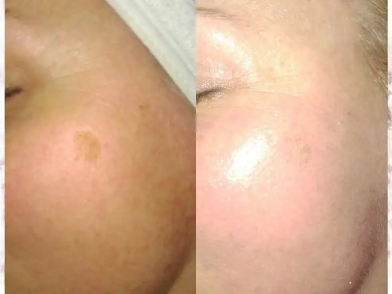 Фото: до и после пилинга Herbs2Peel Alex Cosmetic