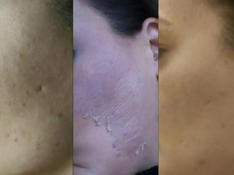 Фото: до и после пилинга Herbs2Peel Alex Cosmetic