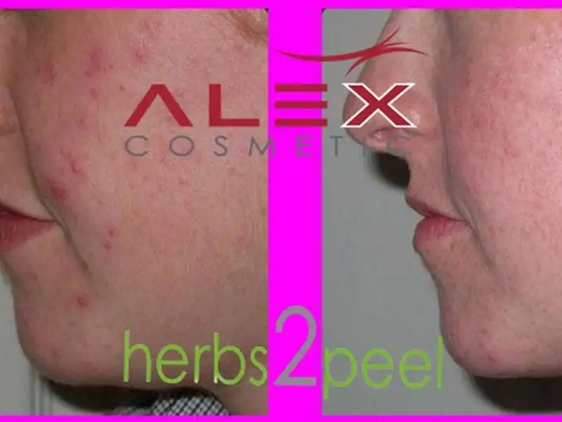 Фото: до и после пилинга Herbs2Peel Alex Cosmetic