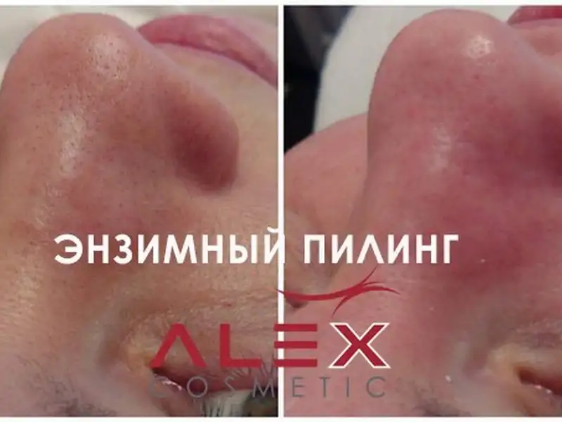 Фото: до и после пилинга Herbs2Peel Alex Cosmetic