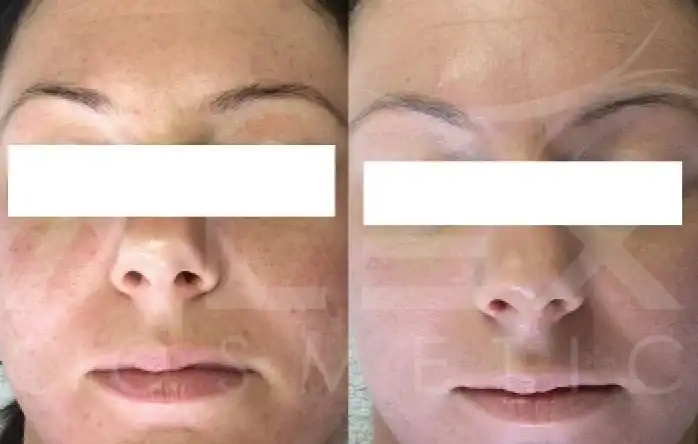 Фото: до и после пилинга Herbs2Peel Alex Cosmetic