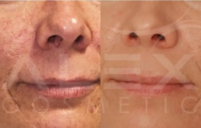 Фото: до и после пилинга Herbs2Peel Alex Cosmetic