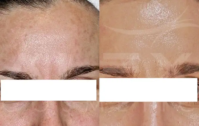 Фото: до и после пилинга Herbs2Peel Alex Cosmetic