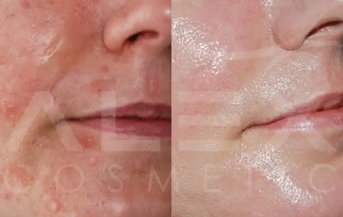 Фото: до и после пилинга Herbs2Peel Alex Cosmetic