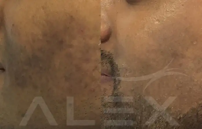 Фото: до и после пилинга Herbs2Peel Alex Cosmetic