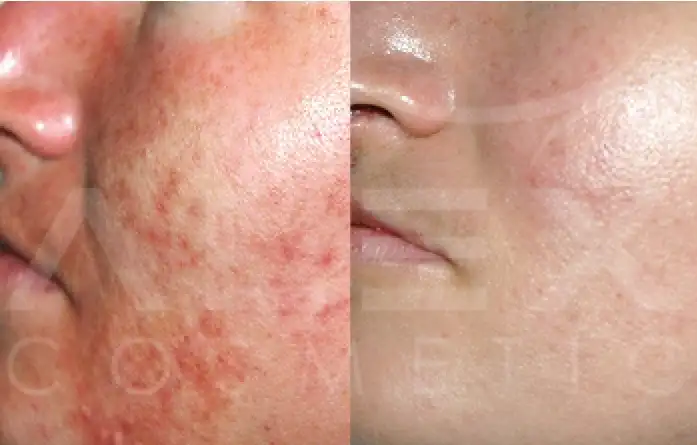 Фото: до и после пилинга Herbs2Peel Alex Cosmetic