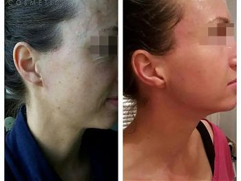 Пилинги Herbs2Peel ДО И ПОСЛЕ