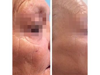 Пилинги Herbs2Peel ДО И ПОСЛЕ