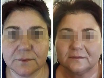 Пилинги Herbs2Peel ДО И ПОСЛЕ