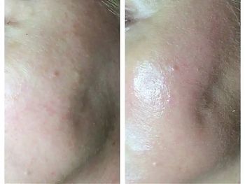 Пилинги Herbs2Peel ДО И ПОСЛЕ