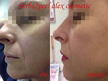 Пилинги Herbs2Peel ДО И ПОСЛЕ
