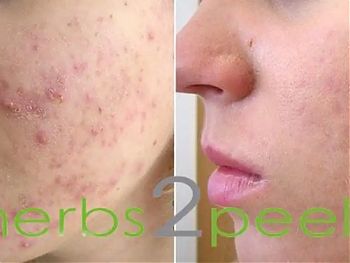 Пилинги Herbs2Peel ДО И ПОСЛЕ